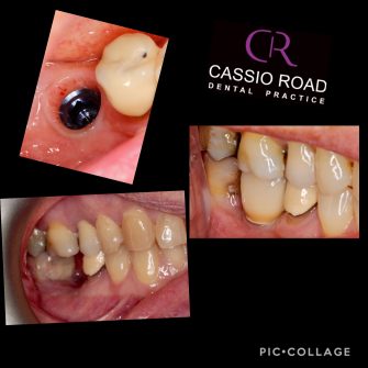 Before After - Cassio Road