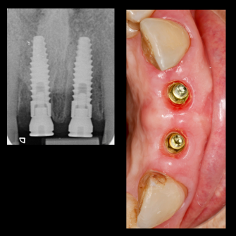 Before After - Cassioroad