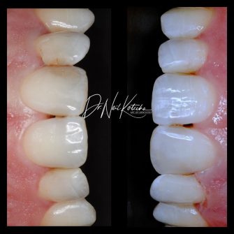 Before After - Cassio Road