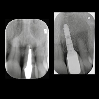 Before After - Cassioroad