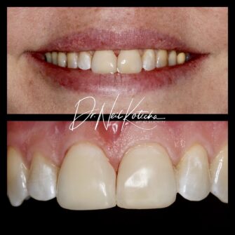 nk comp veneers 2 oct 21