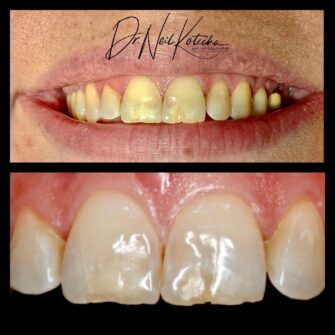 nk comp veneers oct 21