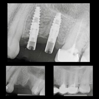 nk implant apr 22 5