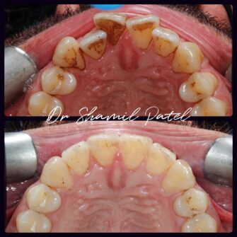 sp invisalign 3 mar 23