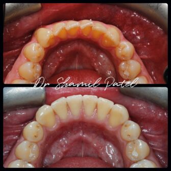 sp invisalign 4 mar 23