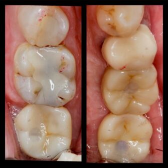 implant case 2 3 apr 23