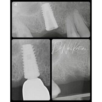 nk implant case nov 23