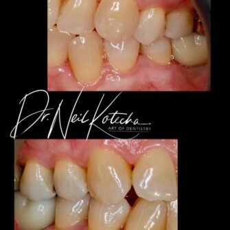 nk implant dec 23 1