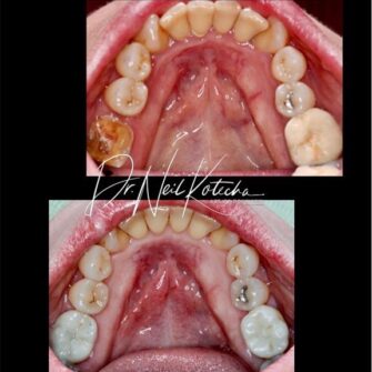 nk implant dec 23 2