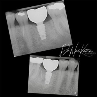 nk implant dec 23 3