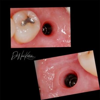 nk implant dec 23 4