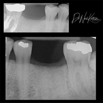 nk implant dec 23 5