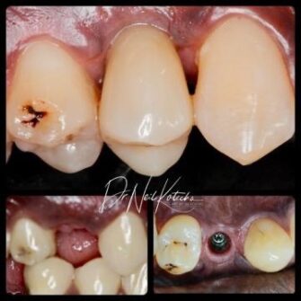 nk implant mar 24 1