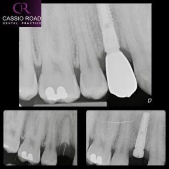 nk implant mar 24 2