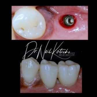 nk implant mar 24 4