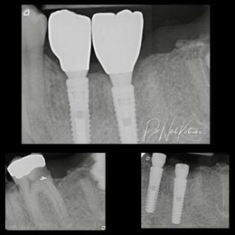 nk implant mar 24 5
