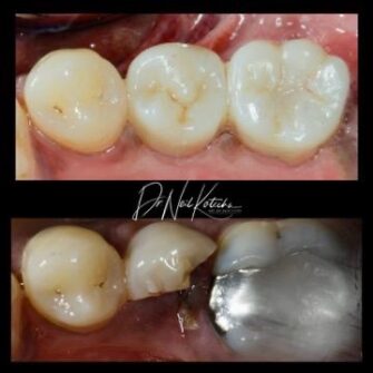 nk implant mar 24 6