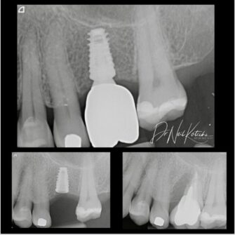 nk implant may 24 2