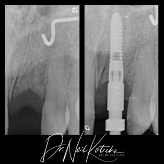 nk implant june 24 1