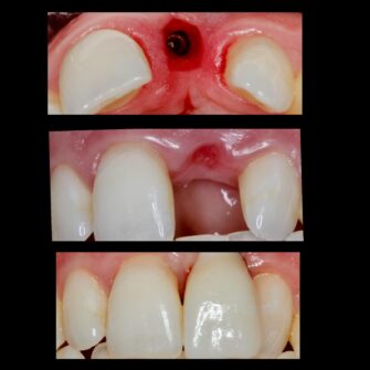 nk implant june 24 2