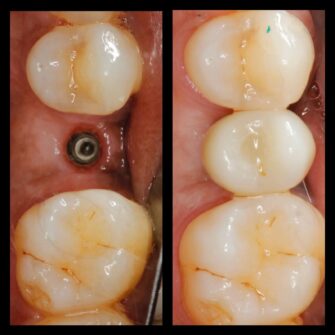 nk implant june 24 5