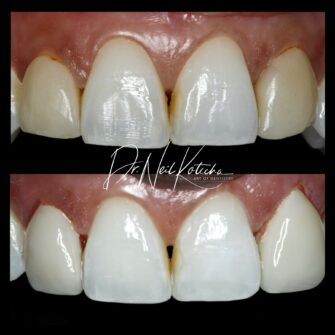 nk veneers jun 24