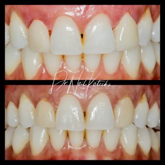 nk veneers jun 24. 2jpg