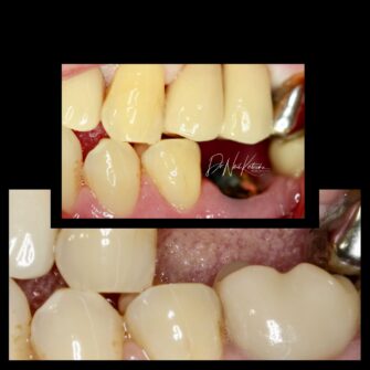 nk implant 1 may 25