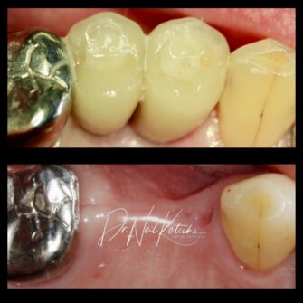 nk implant 2 may 25