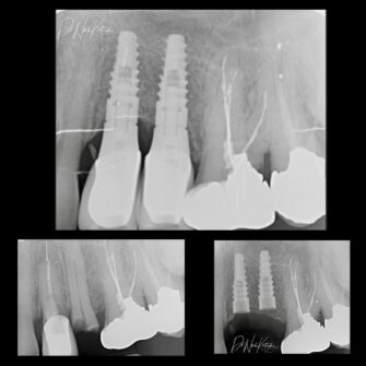 nk implant 3 may 25