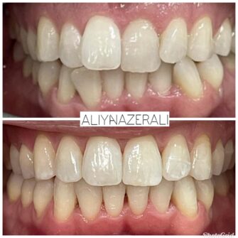 an invisalign case 1 june 25