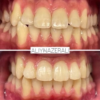 an invisalign case 2 june 25