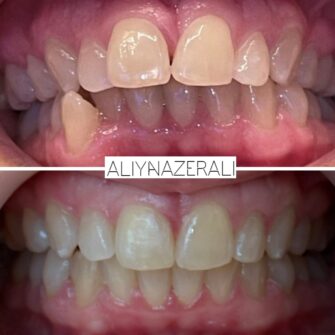 an invisalign case 3 june 25
