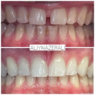 an invisalign case 4 june 25