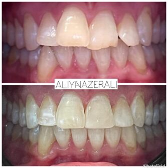 an invisalign case 5 june 25