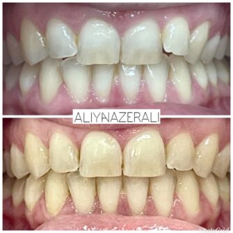 an invisalign case 6 june 25