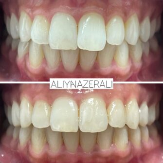 an invisalign case 7 june 25