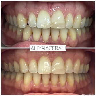 an invisalign case 8 june 25