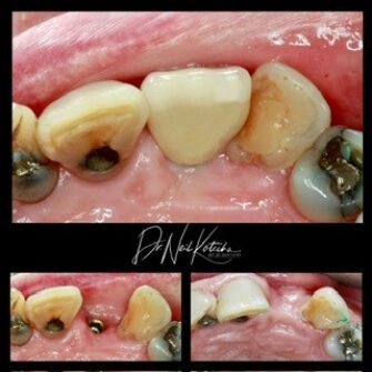nk implant 1 june 25