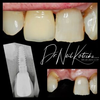 nk implant 2 june 25