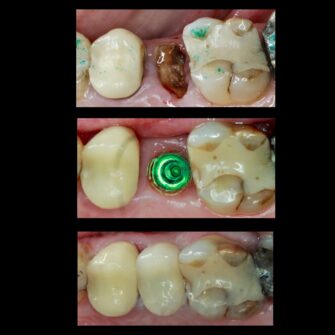 nk implant 3 june 25