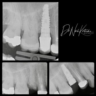 nk implant 4 june 25