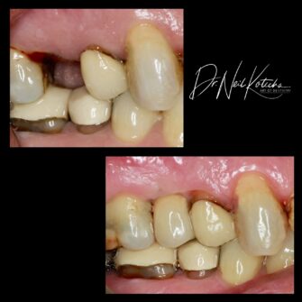 nk implant 5 june 25