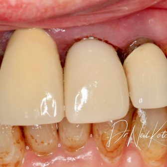 Before After - Cassioroad