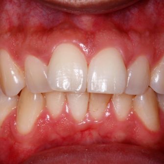 Before After - Cassioroad