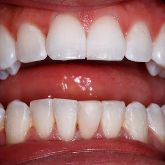 Before After - Cassioroad