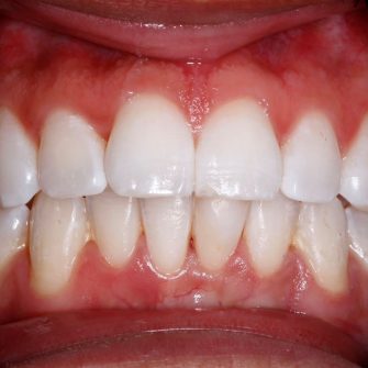 Before After - Cassioroad